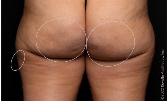 woman's buttocks 3 months after aveli treatment