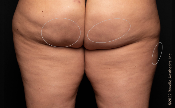 woman's buttocks 3 months after aveli treatment