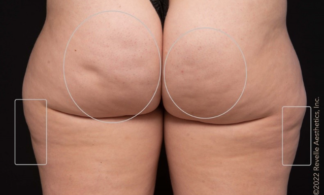 woman's buttocks before aveli treatment