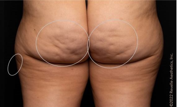 woman's buttocks before aveli treatment