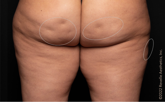 woman's buttocks before aveli treatment