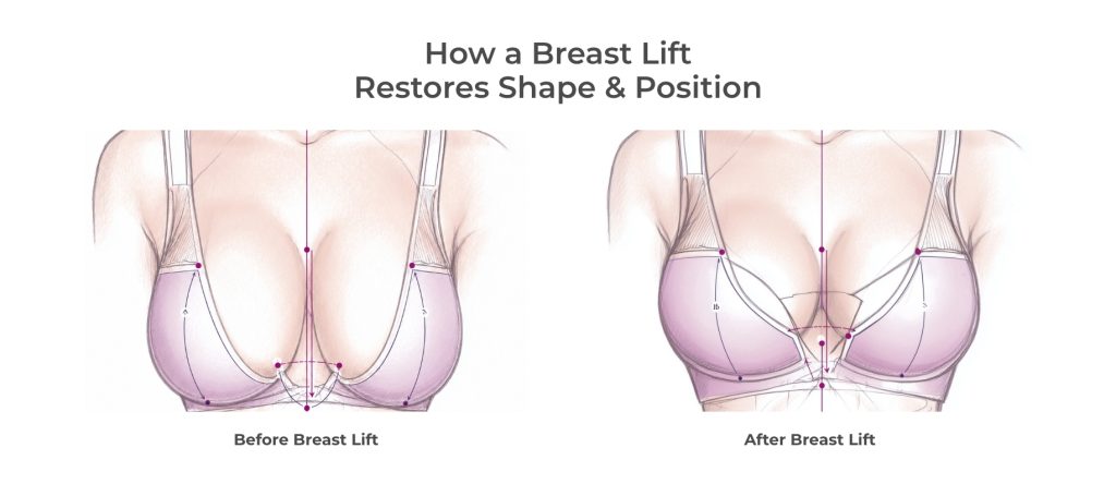 An infographic illustrating how a breast lift restores shape and positions.